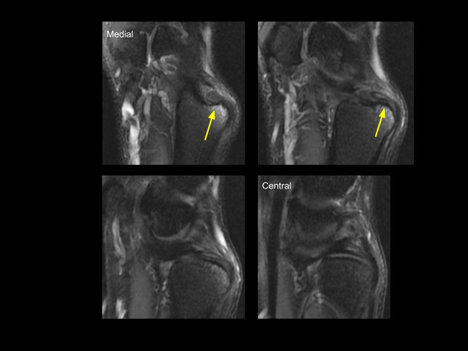 Figure 2 for case extensor carpi ulnaris tendon ( RID2382 )